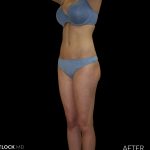 High Def Liposuction Female Before & After Patient #2711