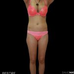 High Def Liposuction Female Before & After Patient #2711