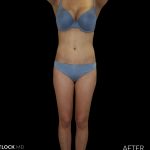 High Def Liposuction Female Before & After Patient #2711