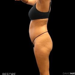 High Def Liposuction Female Before & After Patient #2712