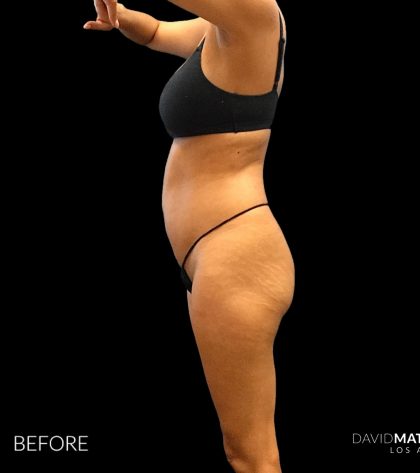 High Def Liposuction Female Before & After Patient #2712