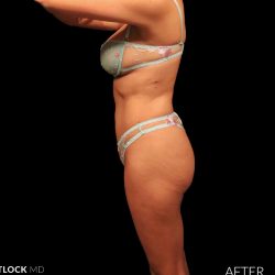 High Def Liposuction Female Before & After Patient #2712