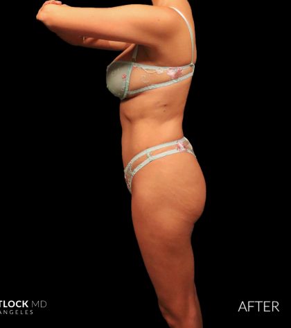 High Def Liposuction Female Before & After Patient #2712