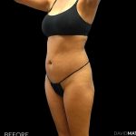 High Def Liposuction Female Before & After Patient #2712