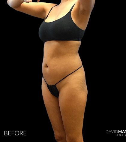 High Def Liposuction Female Before & After Patient #2712