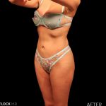 High Def Liposuction Female Before & After Patient #2712