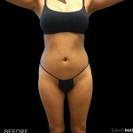 High Def Liposuction Female Before & After Patient #2712