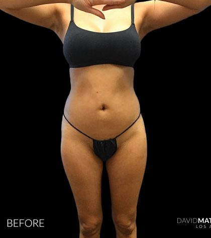 High Def Liposuction Female Before & After Patient #2712