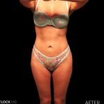 High Def Liposuction Female Before & After Patient #2712