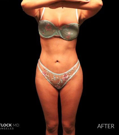High Def Liposuction Female Before & After Patient #2712
