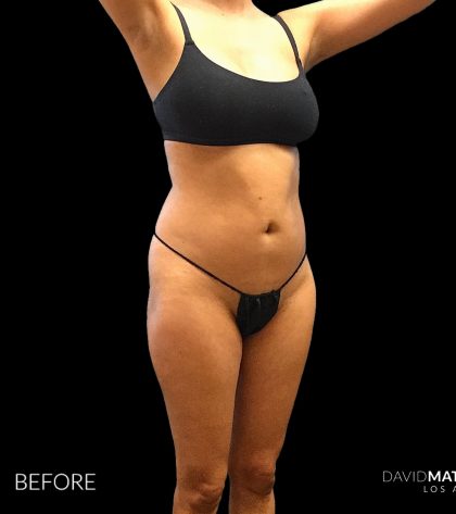 High Def Liposuction Female Before & After Patient #2712