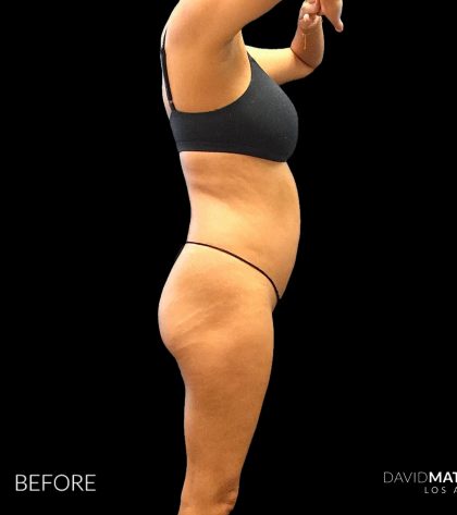 High Def Liposuction Female Before & After Patient #2712