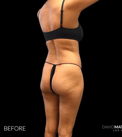 High Def Liposuction Female Before & After Patient #2712