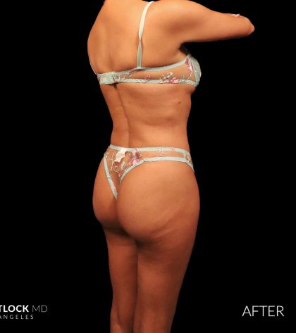 High Def Liposuction Female Before & After Patient #2712