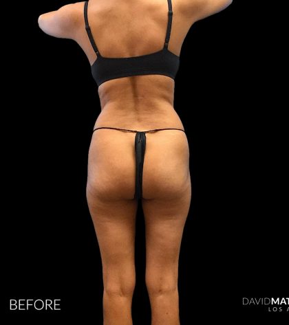 High Def Liposuction Female Before & After Patient #2712