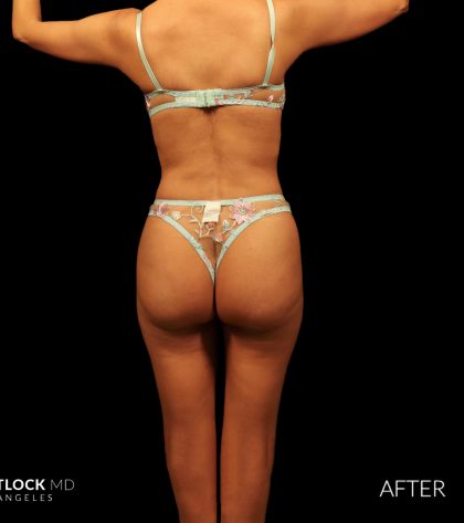 High Def Liposuction Female Before & After Patient #2712