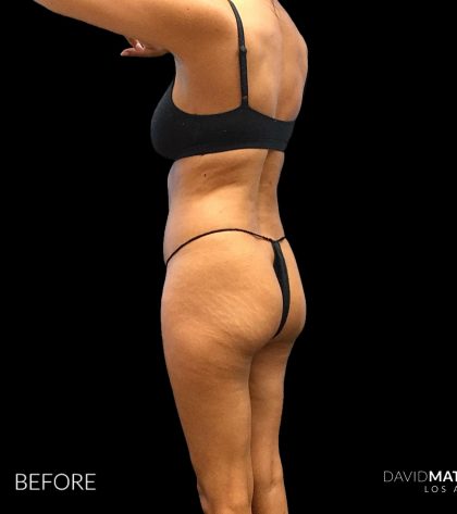 High Def Liposuction Female Before & After Patient #2712