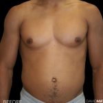 High Def Liposuction Male Before & After Patient #2737