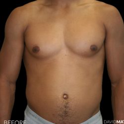 High Def Liposuction Male Before & After Patient #2737