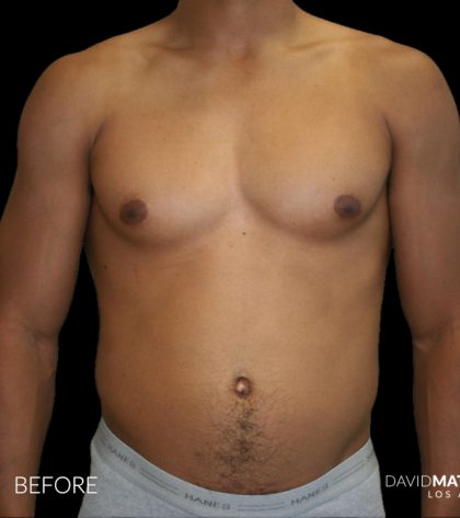 High Def Liposuction Male Before & After Patient #2737