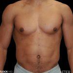 High Def Liposuction Male Before & After Patient #2737