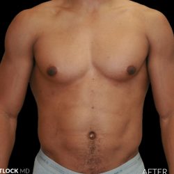 High Def Liposuction Male Before & After Patient #2737