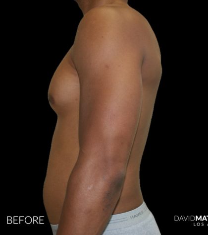 High Def Liposuction Male Before & After Patient #2737