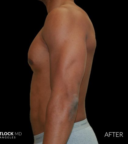High Def Liposuction Male Before & After Patient #2737