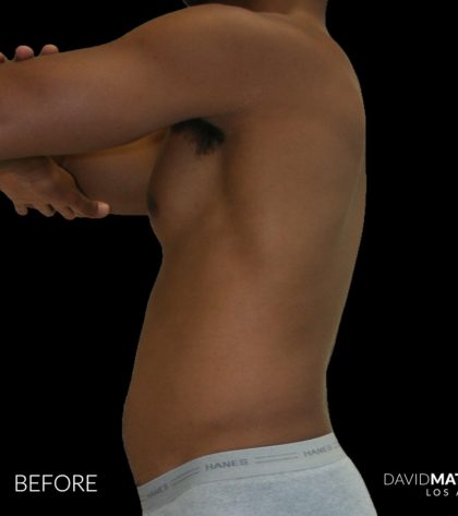 High Def Liposuction Male Before & After Patient #2737