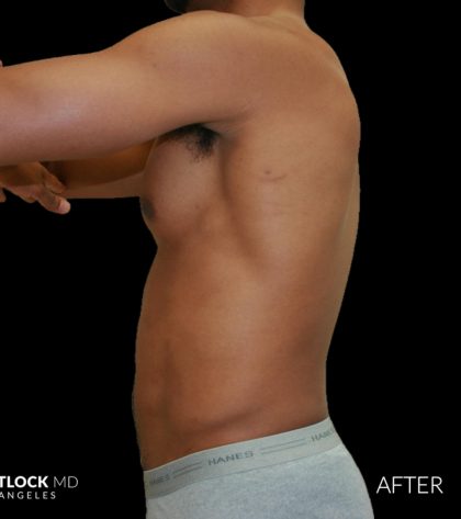 High Def Liposuction Male Before & After Patient #2737