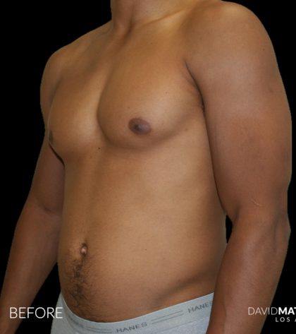 High Def Liposuction Male Before & After Patient #2737
