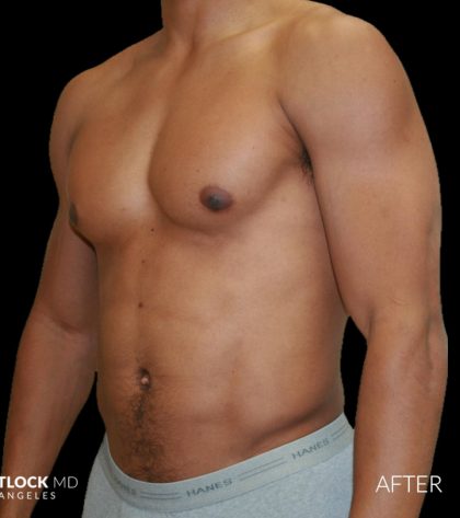 High Def Liposuction Male Before & After Patient #2737