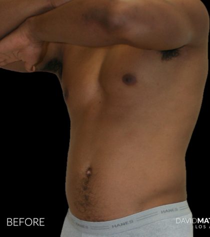 High Def Liposuction Male Before & After Patient #2737