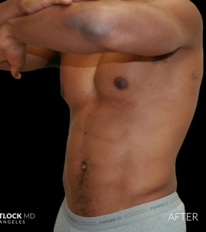 High Def Liposuction Male Before & After Patient #2737