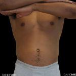 High Def Liposuction Male Before & After Patient #2737