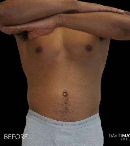 High Def Liposuction Male Before & After Patient #2737