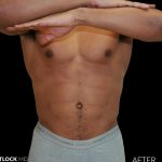 High Def Liposuction Male Before & After Patient #2737