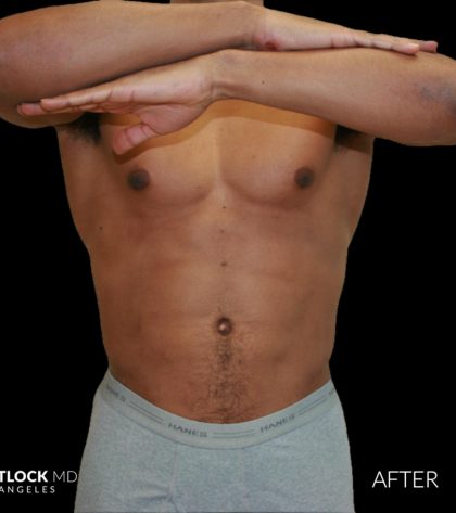 High Def Liposuction Male Before & After Patient #2737