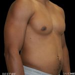 High Def Liposuction Male Before & After Patient #2737