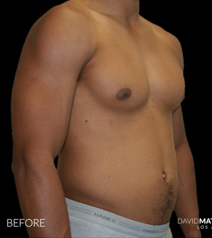 High Def Liposuction Male Before & After Patient #2737