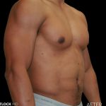 High Def Liposuction Male Before & After Patient #2737