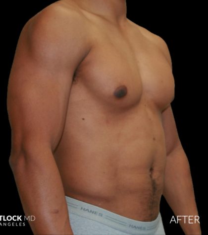 High Def Liposuction Male Before & After Patient #2737