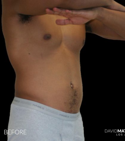 High Def Liposuction Male Before & After Patient #2737