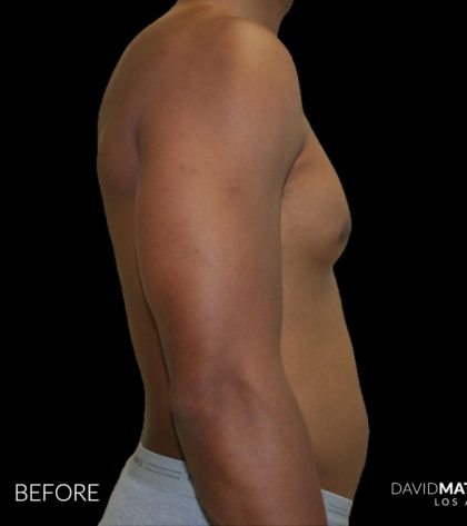 High Def Liposuction Male Before & After Patient #2737