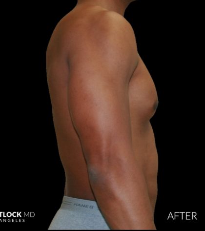 High Def Liposuction Male Before & After Patient #2737