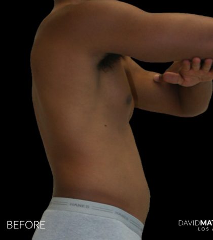 High Def Liposuction Male Before & After Patient #2737
