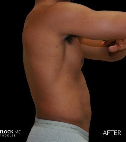 High Def Liposuction Male Before & After Patient #2737