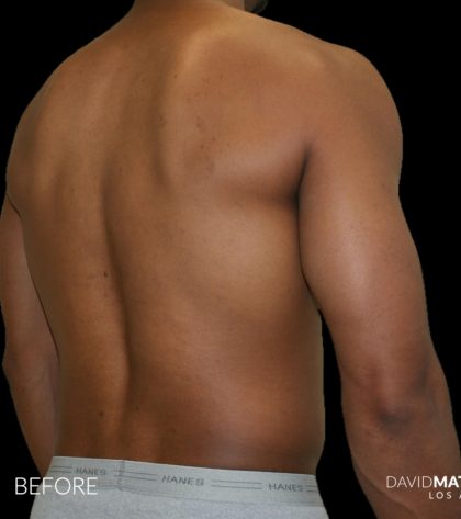 High Def Liposuction Male Before & After Patient #2737