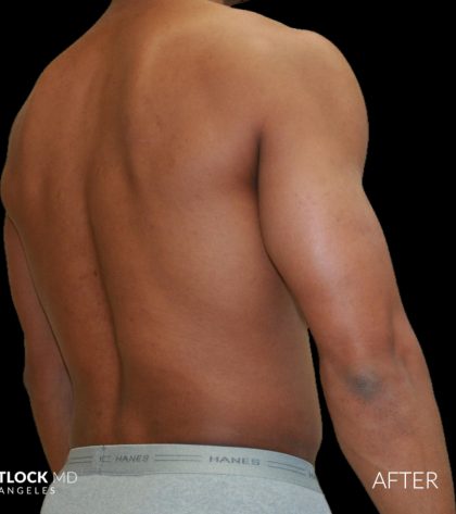 High Def Liposuction Male Before & After Patient #2737