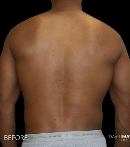 High Def Liposuction Male Before & After Patient #2737
